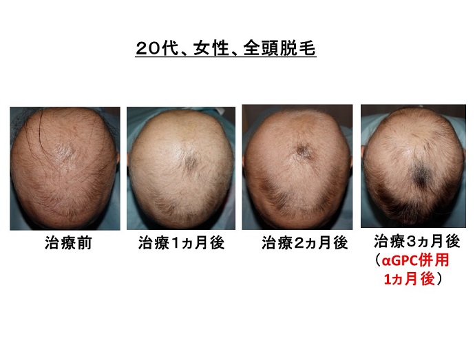 円形脱毛症　病院